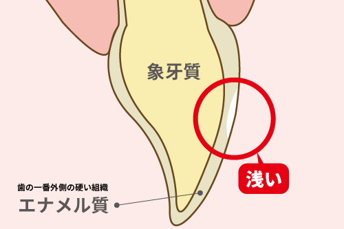 歯にできたホワイトスポット