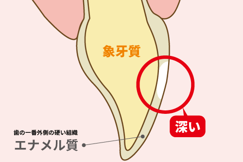 歯にできたホワイトスポット