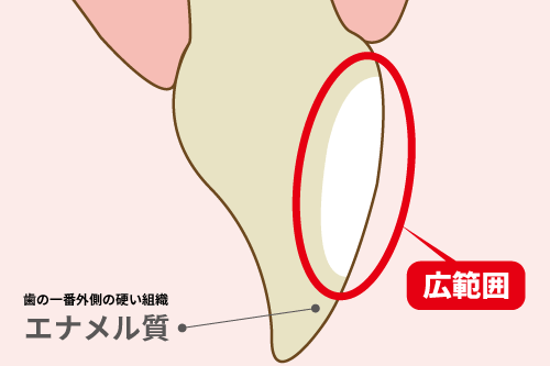歯にできたホワイトスポット