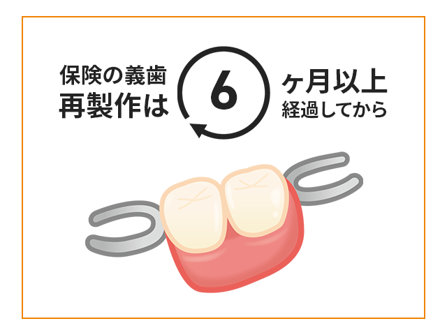 保険の入れ歯の再製作は6ヶ月後から
