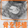ブロック骨移植
