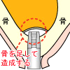 ソケットリフト
