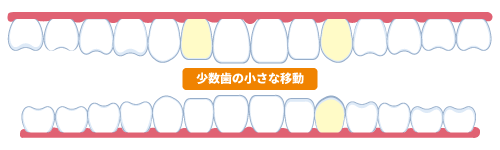 インビザラインExpressの適応歯イメージ