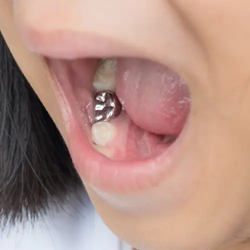 セラミックの歯