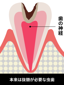 神経近くまで侵されたむし歯