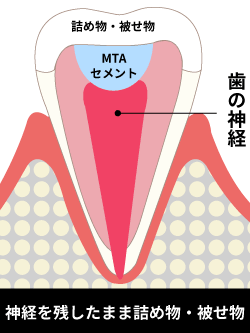 MTAセメントで神経を残して被せ物