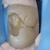 MTAセメント