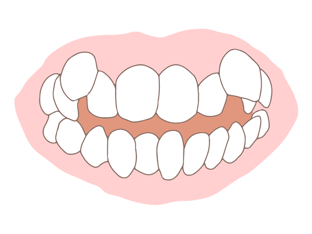 叢生（ガタガタの歯並び）のイメージ