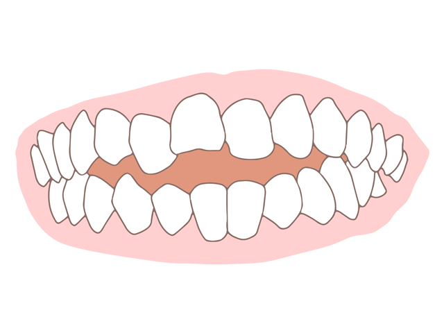 開咬のイメージ