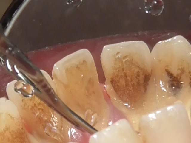 保険診療のクリーニングで歯石を取り除く様子