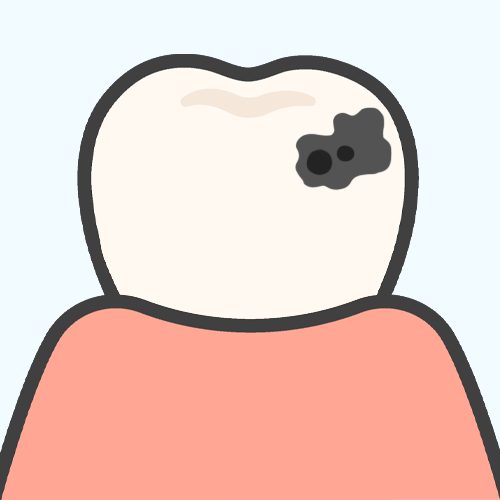 虫歯のある歯のイラスト
